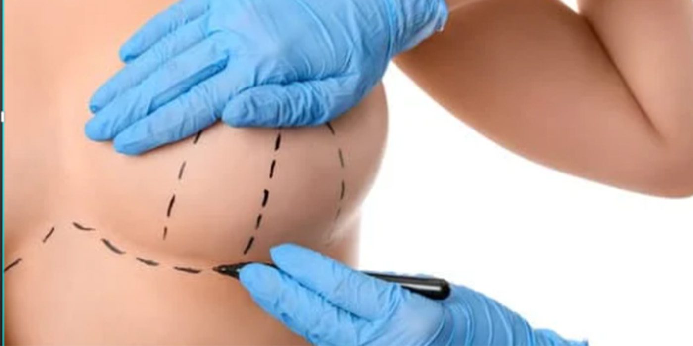 360 liposuction