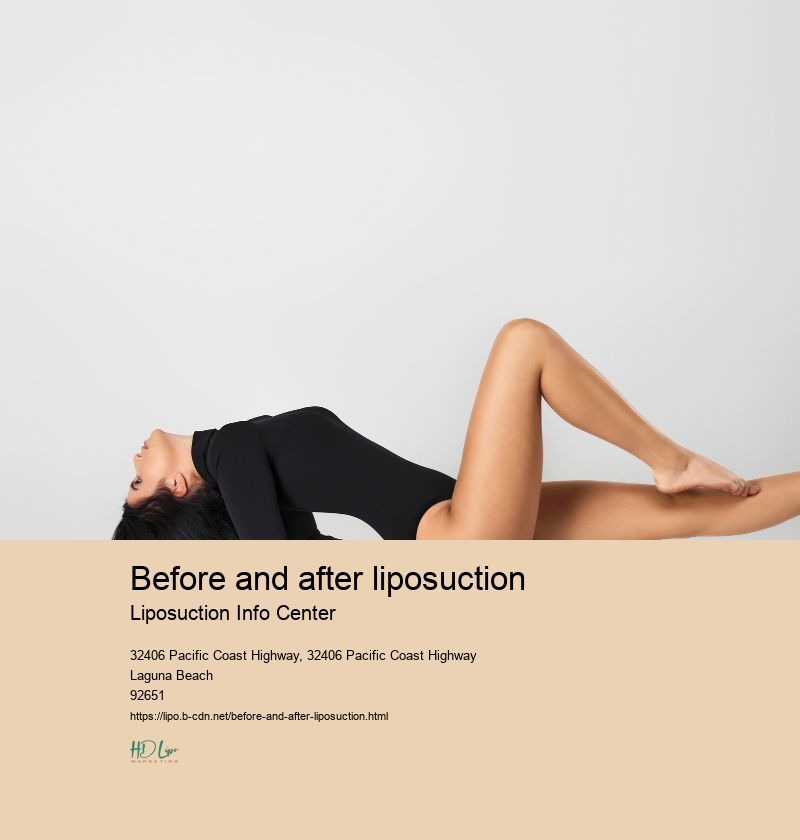 before and after liposuction