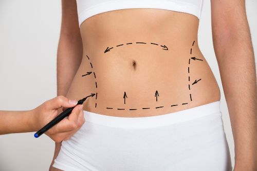 traditional liposuction