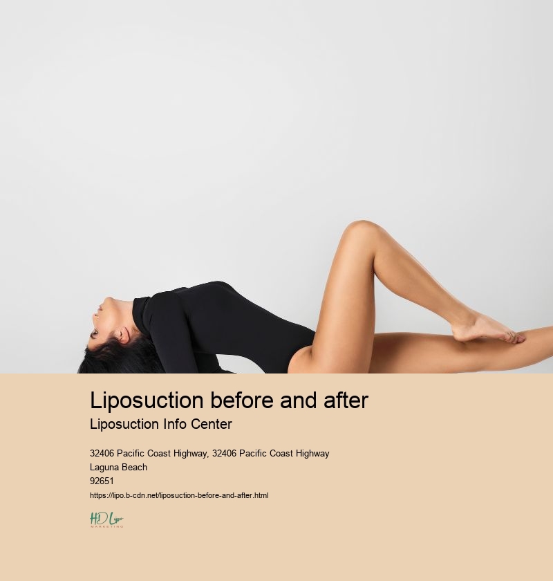 liposuction before and after